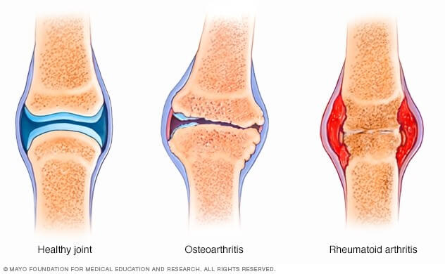 mlsportsphysio-osteoarthritis
