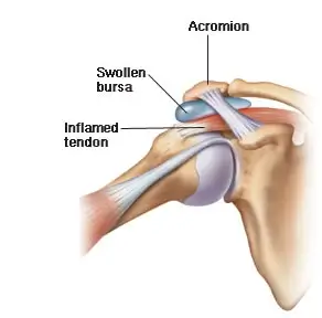 mitch-lenkic-shoulder-impingement-02
